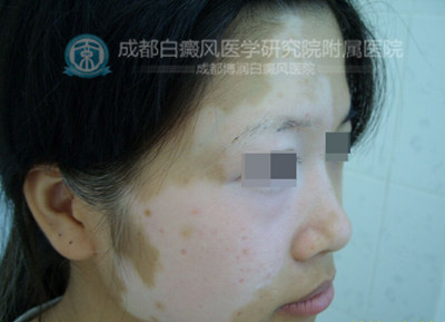 女性白癜风危害有哪些?