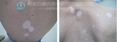 男性得了白癜风会影响下一代吗?